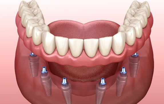 3D model of implant dentures