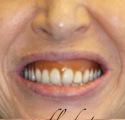 Closeup of gummy smile before treatment