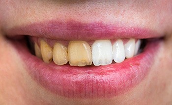 Before and after teeth whitening