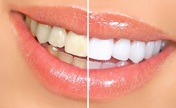 Before and after teeth whitening close up