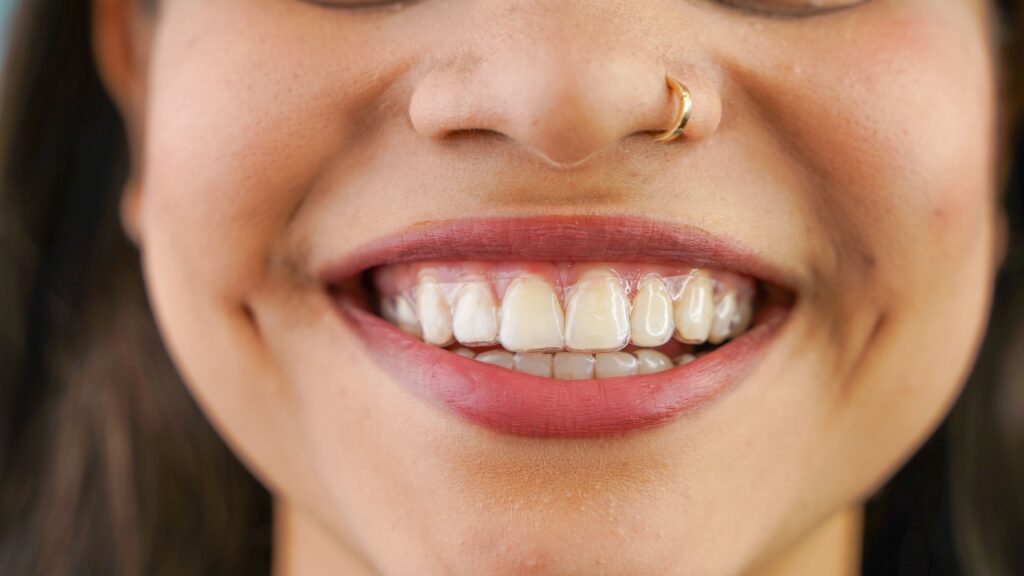 Closeup of woman with nose ring wearing Invisalign